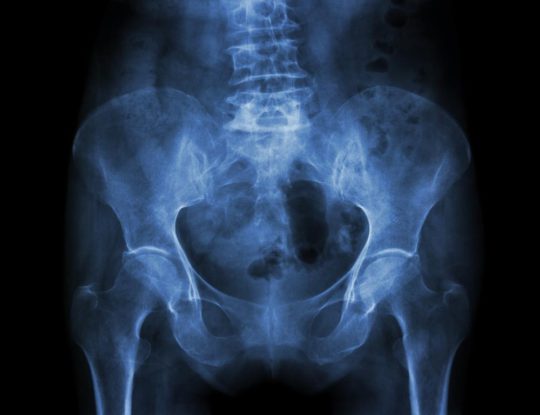 WERELDPRIMEUR: Introductie van LOEP (Local Osteo-Enhancement Procedure) maakt Orthokliniek en AZ Nikolaas pioniers in de behandeling van osteoporose