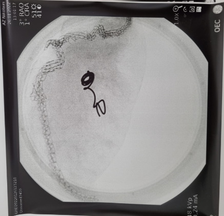 Primeur in VITAZ: pre-operatieve coiling van kleine longletsels gevolgd door minimaal invasieve longchirurgie