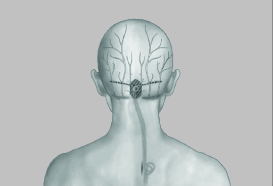 Het multidisciplinair pijncentrum van Vitaz is erkend als implantcentrum voor occipitale neurostimulatie bij refractaire clusterhoofdpijn